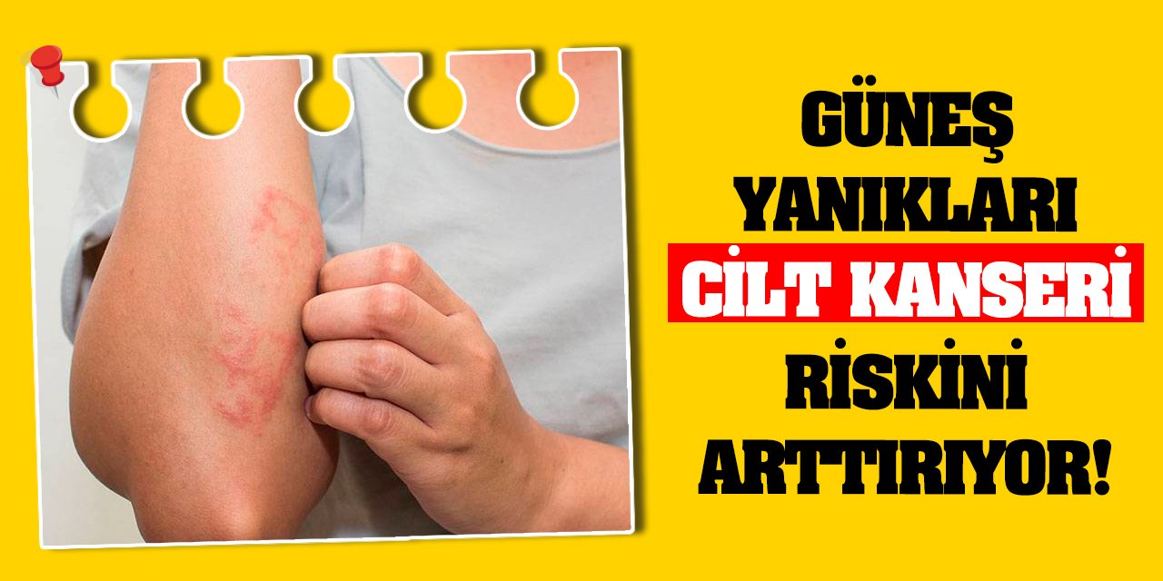 Güneş yanıkları cilt kanseri riskini arttırıyor!