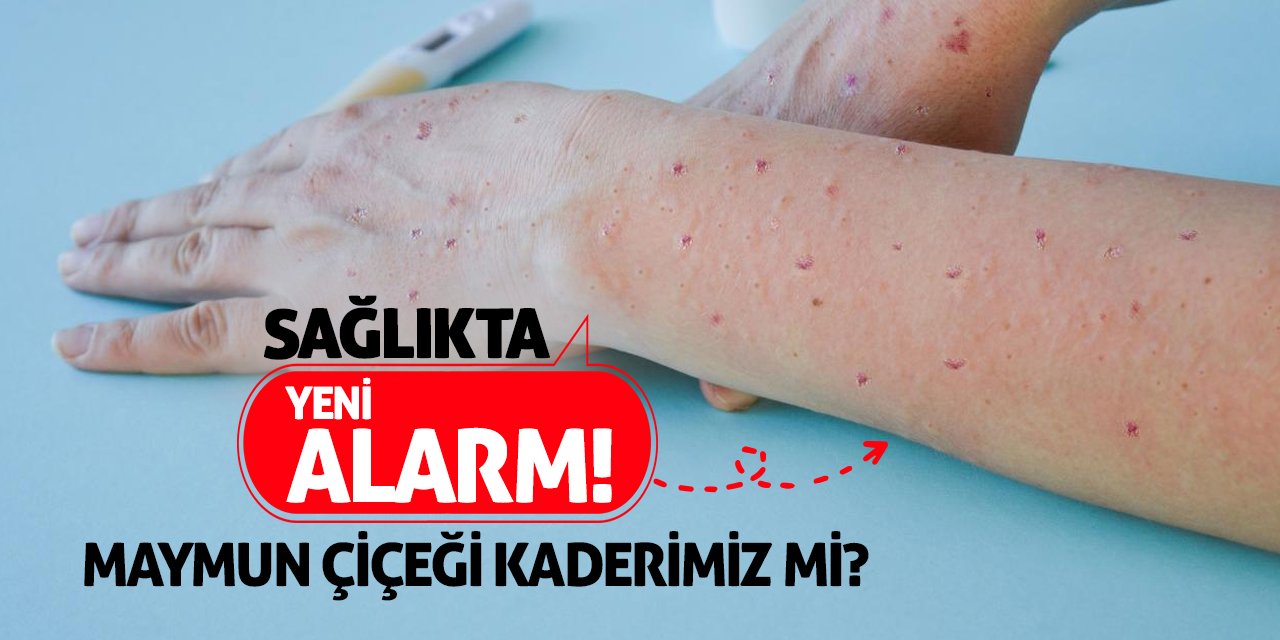 Sağlıkta Yeni Alarm! Maymun Çiçeği Kaderimiz Mi?