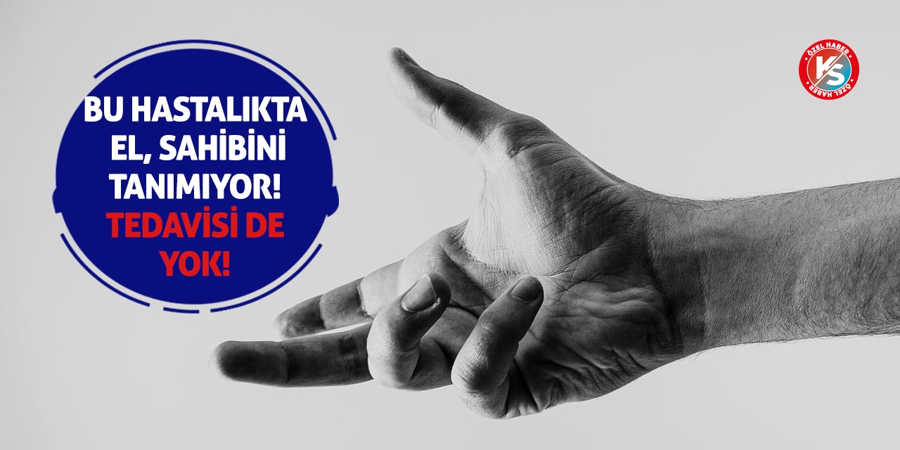 Bu Hastalıkta El, Sahibini Tanımıyor! Tedavisi de yok!