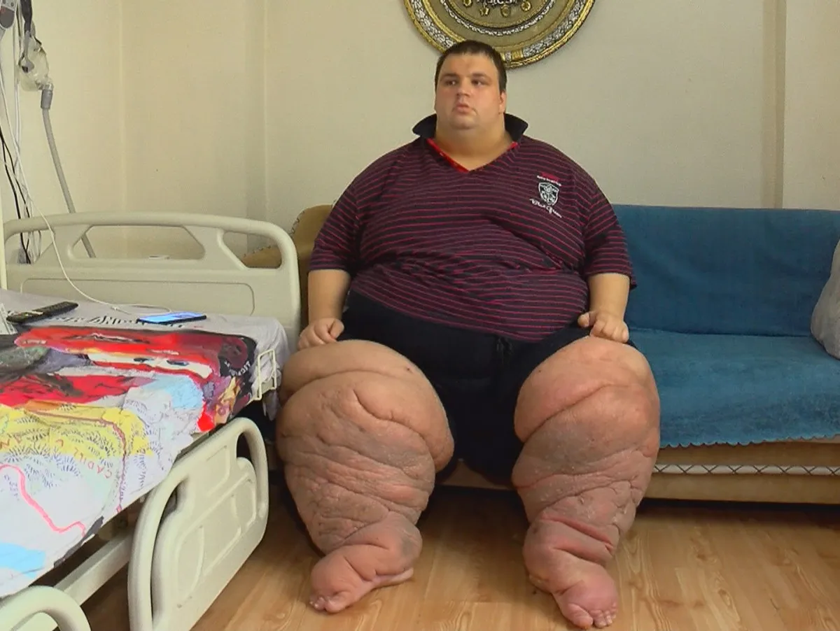 270 Kiloya Çıkaran Fil Hastalığı Şok Etti!