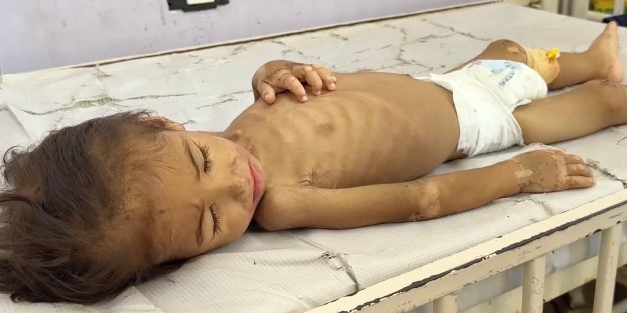 Gazze'de hastanelerdeki çocuklar adeta açlıktan ölümü bekliyor