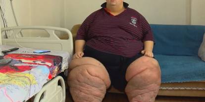 270 Kiloya Çıkaran Fil Hastalığı Şok Etti!